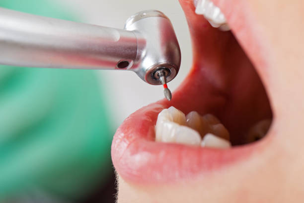 Best Emergency Tooth Extraction in Lancaster, KY